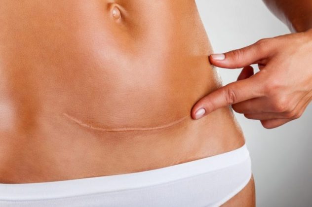 Восстановление после кесарева сечения: рекомендации о том, что можно и нельзя делать