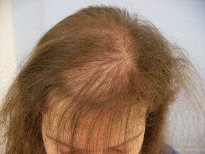 Как остановить выпадение волос после родов