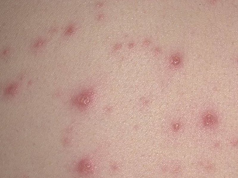 Аллергическая сыпь на теле у ребенка: причины, фото и пояснения