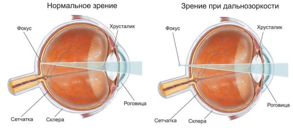 Нормальное зрение и зрение при дальнозоркости