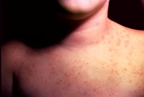 Энтеровирусная инфекция у детей: симптомы и лечение сыпи (диета, препараты)