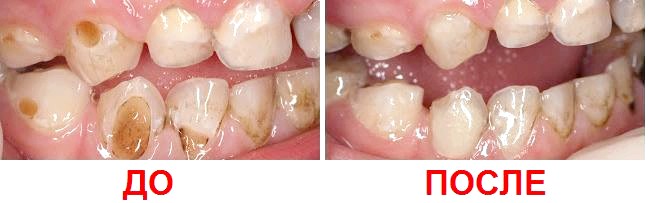 Фторирование зубов у детей — что это такое, как выглядит на фото до и после процедуры?