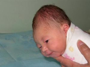  гематомы у новорожденного на голове после родов