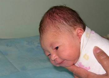 кефалогематома после родов образовалась у новорожденного на голове