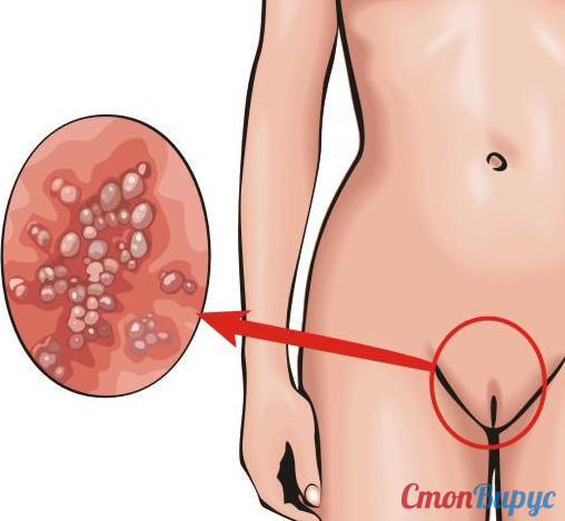 Генитальный герпес у детей: причины возникновения, симптомы и лечение