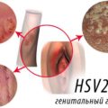 Генитальный герпес HSV2