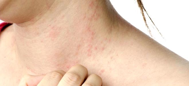 Герпес у детей: симптомы и лечение вируса, фото сыпи на теле, виды и профилактика