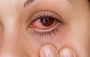 фото катарального конъюнктивита глаз