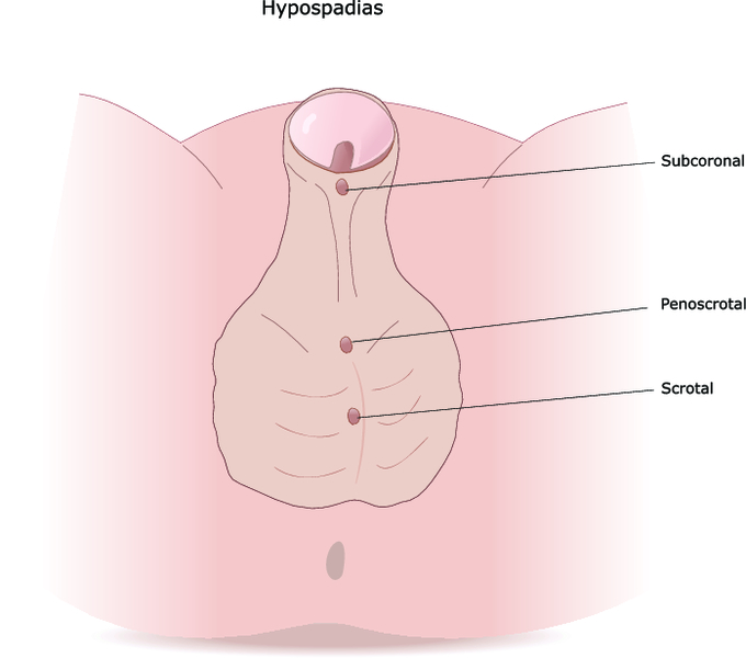 Гипоспадия у мальчиков: что это такое, фото у новорожденных детей, головчатая, венечная и другие