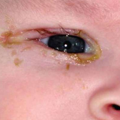 Детский глаз с конъюктивитом