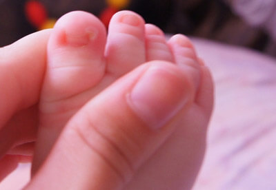 Вросший ноготь у ребенка: лечение медикаментозное и домашние способы
