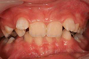 Фото: Скученность зубов верхней челюсти у ребёнка в 8 лет..