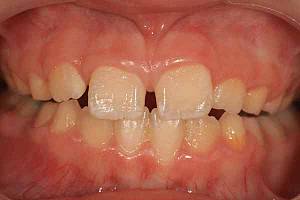 Зубной ряд в 9 лет
