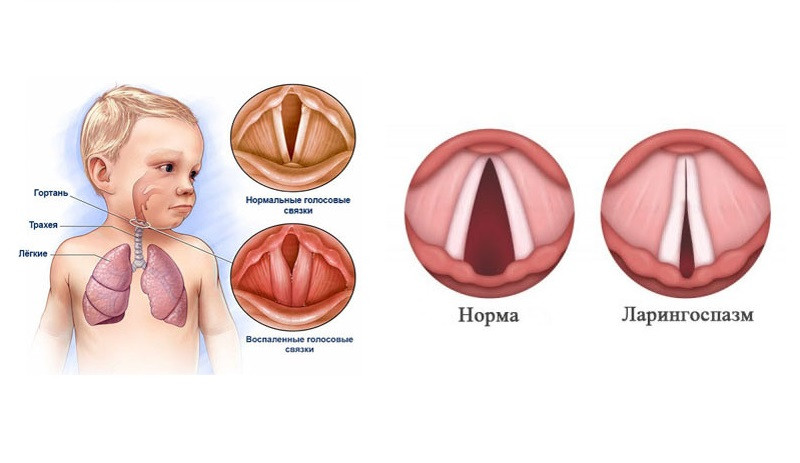 Ларингоспазм у детей — неотложная помощь, симптомы и лечение при спазме гортани