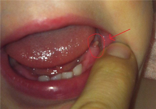 Нарост на десне у ребенка — фото эпулиса, симптомы при прорезывании зубов, лечение