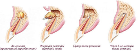 Схема удаления радикулярной кисты на верхнем зубе
