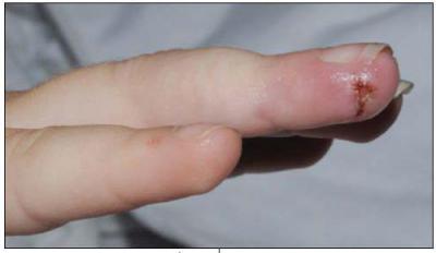 Остеомиелит у детей и новорожденных: симптомы и лечение, причины возникновения