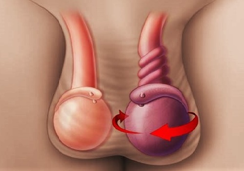 Перекрут гидатиды яичка у детей: симптомы, причины появления у мальчиков, последствия после операции