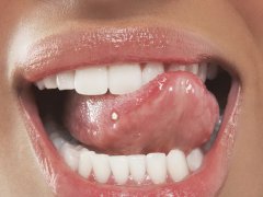 Сыпь на языке — виды образований, этиологические факторы