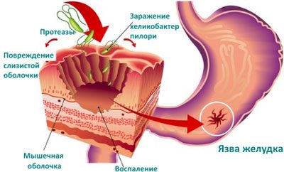 Язвенная болезнь