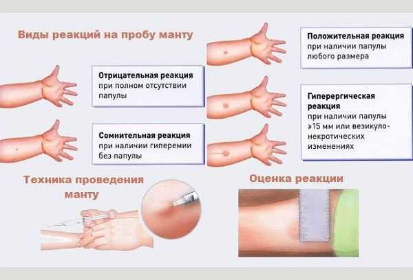 Проба Манту: оценка результата у детей, нормы в таблице, подготовка к прививке, расшифровка реакции