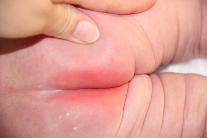 Раздражение на попе у новорожденного ребенка: фото, лечение грудничка