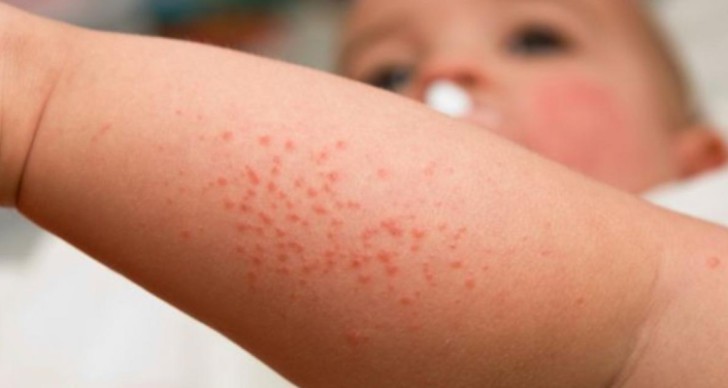 Сыпь на теле у ребенка — фото с пояснениями: мелкая, похожая на мурашки, красная и без зуда
