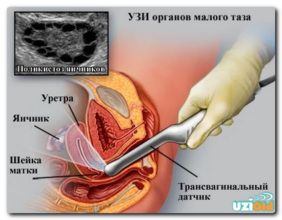 Трансвагинальное УЗИ органов малого таза: как подготовиться, на какой день после месячных делают?