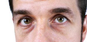 Какая причина вызывает появление синяков под глазами у мужчин?