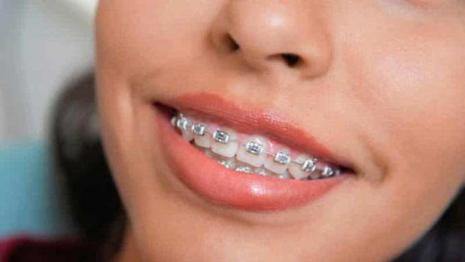 В каком возрасте можно ставить брекеты детям, сколько стоит их поставить?