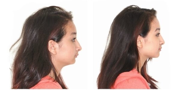 лицо до и после брекетов (2)