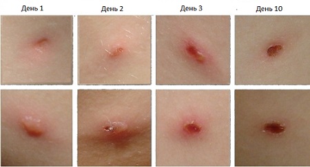 Ветрянка у детей: симптомы и лечение, профилактика, фото оспы на начальной стадии