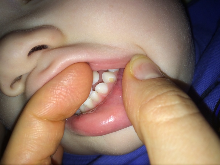пятна у детей не зубах