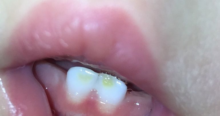 желтое пятно на зубике у ребенка