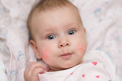 Аллергия на грудное молоко у грудничков: симптомы непереносимости у ребенка