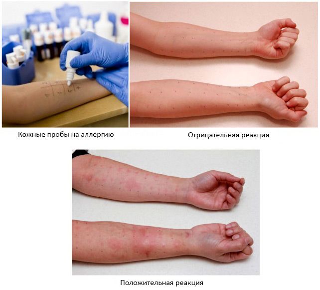 Анализ на аллергены у ребенка: сдача крови, кожные пробы, провокационный тест при аллергии