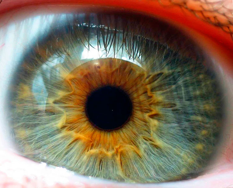 Ангиопатия сетчатки глаза у ребенка — что это такое и как лечится?