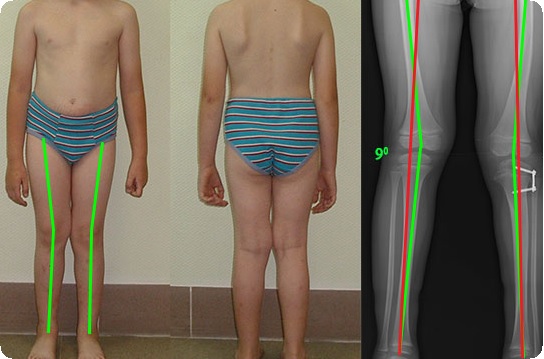 Болезнь Блаунта у детей (с фото) — симптомы и лечение заболевания