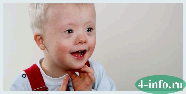 Болезнь Дауна: признаки синдрома у плода при беременности, причины возникновения факторы риска