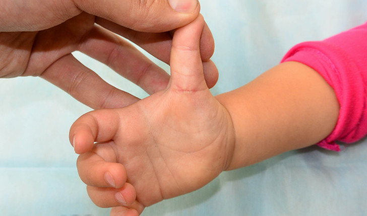 Болезнь Нотта у детей: причины возникновения, симптомы с фото и особенности лечения