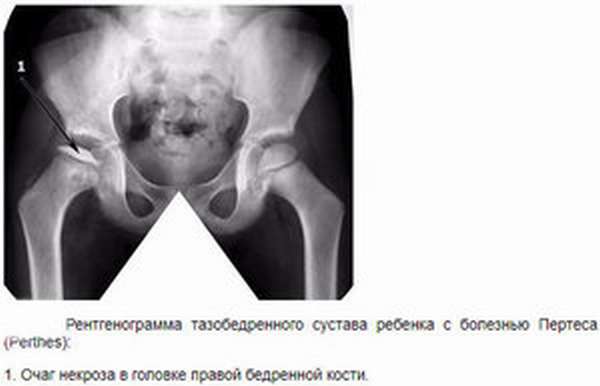 Болезнь Пертеса у детей — симптомы заболевания тазобедренного сустава, причины и лечение