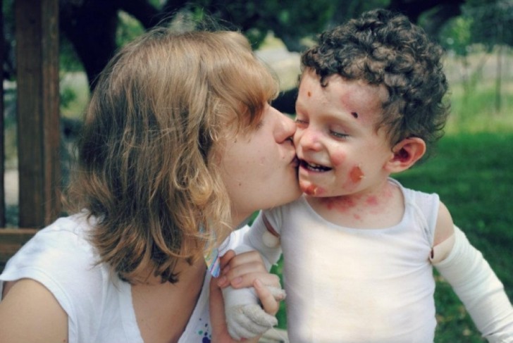 Буллезный эпидермолиз («дети-бабочки»): фото, продолжительность жизни, прогноз