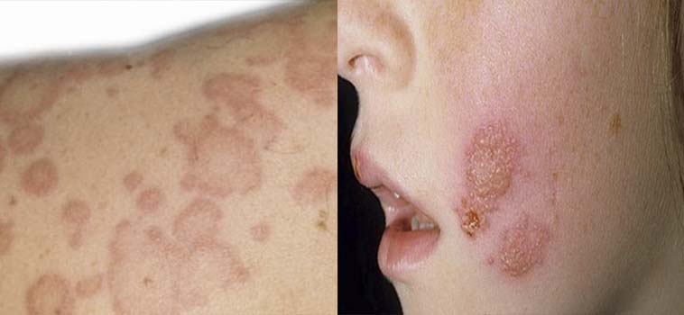 Чем лечить лишай у ребенка в домашних условиях, как вывести, чтобы быстро прошел: народные средства