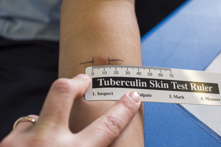 Через сколько дней проверяют Манту у ребенка и как измерить ее правильно в домашних условиях (фото)?