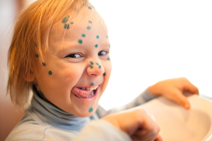 Диета при ветрянке у детей — особенности питания: что можно есть, а что нельзя?