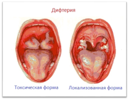 Дифтерия у детей: симптомы и лечение, профилактика, фото зева и гортани