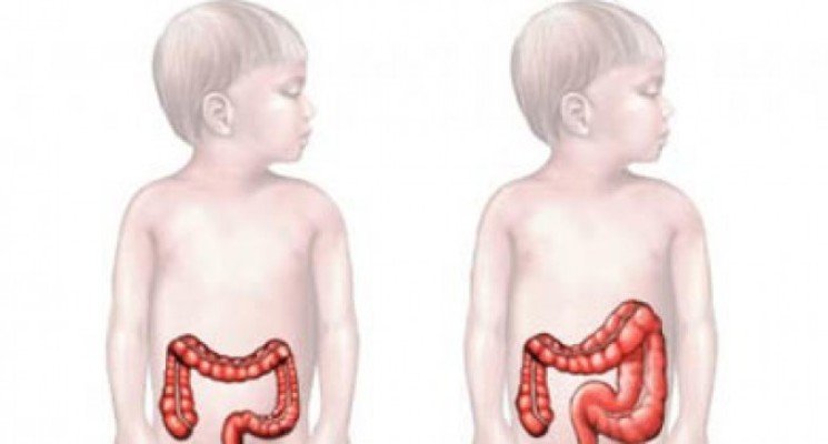 Долихосигма кишечника у ребенка — что это такое, каковы симптомы и лечение болезни?