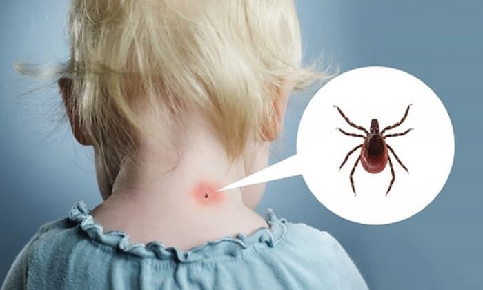 Энцефалит: симптомы у детей при вирусной инфекции после укуса клеща, лечение болезни