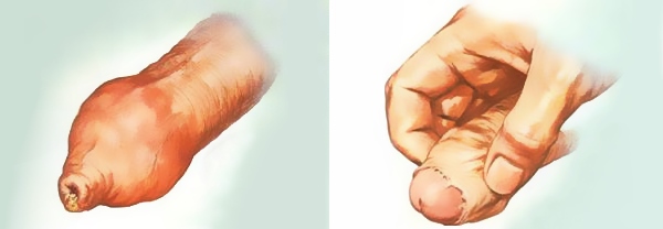 Фимоз у мальчиков: фото до и после операции, лечение в домашних условиях