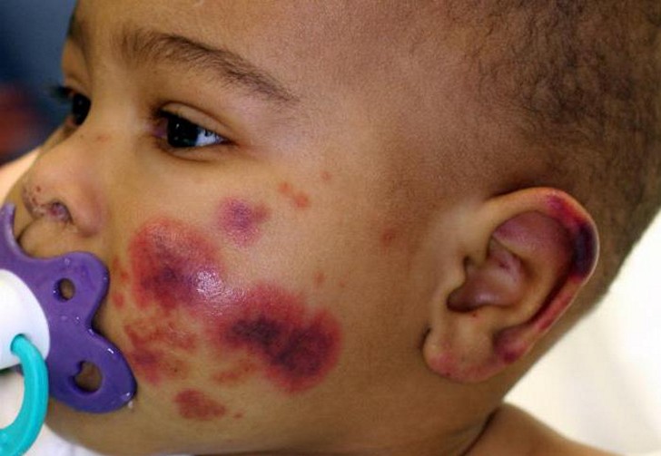 Геморрагическая болезнь новорожденных (поздняя форма): причины, лечение и последствия